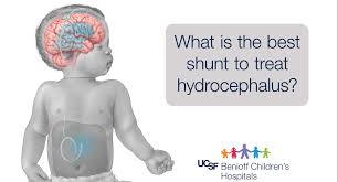 Image result for Hydrocephalus