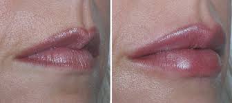 Why do i have pimples in my lip? Treating Smoker S Lines Wrinkles Brisbane S Leading Dermatologist
