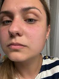 Can I help identify a hot spot or rash?