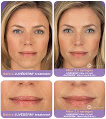 Check spelling or type a new query. Juvederm Voluma Volbella Pasadena La Canada Los Angeles Ca
