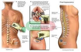 Scs Procedure The Drg Stimulator Is Nearly The Same Procedure But It Only Is For The Lower Limbs Spinal Cord Stimulator Spinal Cord Spinal