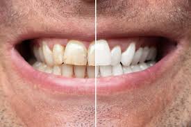 Image result for Tooth Discoloration