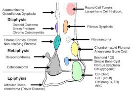 Primary Bone Tumors Systematic Pathology Epomedicine
