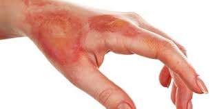 A dry scab or slough, esp one following a burn or cauterization of the skin word origin for eschar c16: Skyscape On Twitter A Nclex Wounds With Eschar Cannot Be Staged Because They Cannot Be Assessed Until The Eschar Is Removed Https T Co Cqthgv9uah Nursing Nclexqow Https T Co J5rgqpkd2j