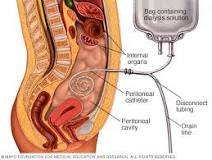 Image result for how frequently does the majority of peritoneal dialysis require treatment