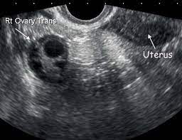 Such cases of bilateral pelvic kidneys can cause serious difficulty in normal delivery/ childbirth. Normal Ovary Ultrasound How To