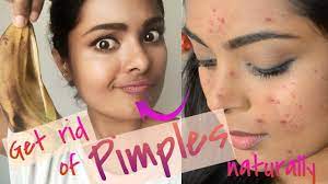 Vetri schloss sich im alter von 17 jahren den tamil tigers an, um in dem mehr als 25 jahre andauernden bürgerkrieg in sri lanka zu kämpfen. How To Get Rid Of Pimples Overnight Really Works Treat Acne At Home Naturally Cheap Diy Skincare Youtube
