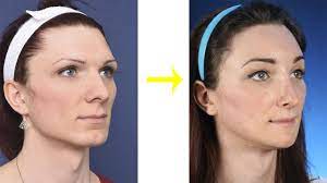Learn male to female makeup and beauty tips that will transform your appearance. Before And After Facial Feminization Surgery Pics Facial Feminization Surgery Facial Surgery Ffs Surgery