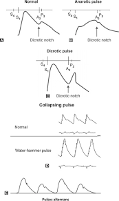 Image result for Collapsing Pulse