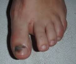 Not keeping your feet clean and dry. The Black Under Your Toenails Is This Fungus