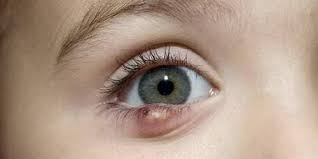 как лечить ячмень на нижнем веке в домашних условиях Yachmen Na Glazu Kak Lechit Bystro