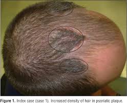 What are scalp psoriasis symptoms and signs? Pdf Scalp Psoriasis A Paradigm Of Switch On Mechanism To Anagen Hair Growth Semantic Scholar
