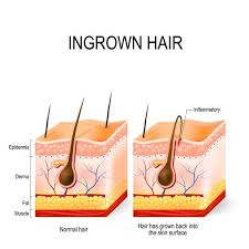 Ingrown hairs can be found on any part of the body that has hair and can. How Does An Ingrown Hair Look Like Under The Skin Quora