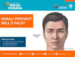 Bell's palsy adalah nama sejenis penyakit kelumpuhan perifer akibat proses (non suppuratif, non neoplasmatik, non degeneratif primer), namun sangat mungkin akibat edema pada nervus fasialis. Kenali Penyakit Bell S Palsy Spesialis Saraf Rumah Sakit