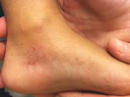 Image result for scabies human bites