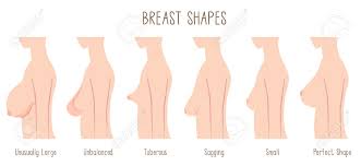 breast shape chart comparing large unbalanced tuberous sagging small