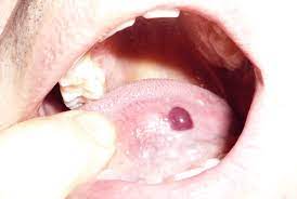 A blood blister inside cheek is a small lump or bump that is filled with blood and other fluids. Blood Blister In Mouth Causes And Remedies