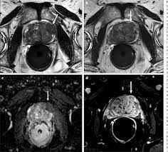 Stage i cancers cannot be felt during a digital rectal exam or seen with imaging tests. Pdf Local Staging Of Prostate Cancer With Mri Semantic Scholar