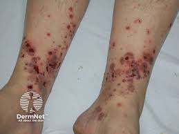 Image result for allergy rash on the legs
