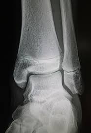 06.04.2018 · maisonneuve fracture is a severe ankle injury which arises due to a spiral fracture of the proximal third of the fibula along with a tear of the distal tibiofibular syndesmosis and interosseous membrane. Maisonneuve Fracture Wikipedia