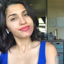 I Spent My Whole Life Hiding My Port Wine Stain Birthmark, Now I'm  Reclaiming My Beauty