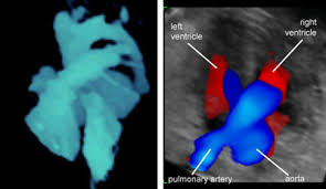 Ultrasound Atlas Glowm The bladder wall thickness was measured from a zoomed image of the transverse plane of the voided bladder at 3 points: ultrasound atlas glowm