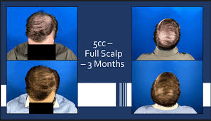 3 month supply £86.97 £59.99 (save 32%) Exosomes Archives Hair Loss Cure 2020