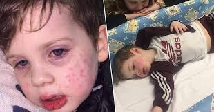 Infection with herpes simplex virus (hsv) is one of the most common infections in the world—and one of the most confusing. Toddler Almost Blinded After Catching Herpes When Kissed By Relative Unilad