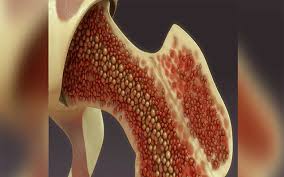 Particularly in prostate cancer, bone metastases tend to be the only site of metastasis. New Drug Offers Hope For Bone Marrow Cancer Patients