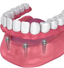 Currently, there's no pricing information for braces procedures at clinica medica and dental de tijuana, as all prices are available on request only, whilst the national average price is approximately $1,950. How Much Do Dental Implants Cost In Mexico Dental News Network