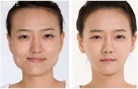 That means waiting at least four hours before laying down and avoiding strenuous exercise for at least 24 hours (all to prevent the botox from migrating to other parts of the face, thereby rendering it ineffective for the problem at hand). Teeth Grinding Face Thinning Orchard House Dental Care