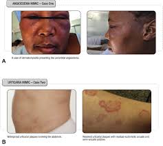 Image result for Angioedema