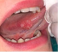 Image result for white cancer on tongue)