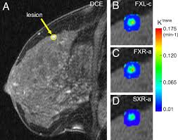 Magnetic resonance imaging (mri) of the breast — or breast mri — is a test used to detect breast cancer and other abnormalities in the breast. The Magnetic Resonance Shutter Speed Discriminates Vascular Properties Of Malignant And Benign Breast Tumors In Vivo Pnas
