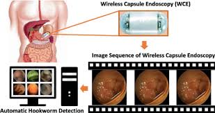 Image result for Wireless Capsule Endoscopy