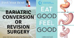 Bariatric Conversion Or Revision Surgery Tijuana Dr Sergio Verboonen Revision Surgery Bariatric Sleeve Surgery