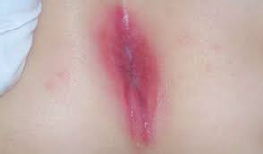 Image result for itchy skin rectum