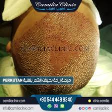 زراعة الشعر في تركيا كاميليا كلينك مرحلة زرع بصيلات الشعر بـ جلسة واحدة و بكثافة عالية تغطية كاملة لمنطقة الصلع التقنية المستخدمة تقنية البيركوتان