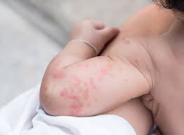 Image result for sweat rash on back baby