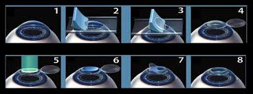 Image result for prk laser eye surgery