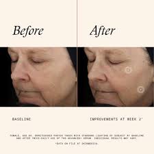 SCS Anti Acne Treatment Best Products for acne Issues Grab your Order Now