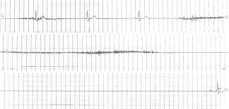 Sinus Node Dysfunction Sick Sinus Syndrome Litfl Ecg Library
