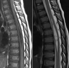 Image result for Syringomyelia