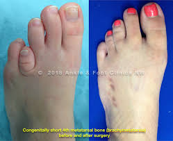 Common foot deformity seen in children which causes the foot to turn inwards. Brachymetatarsia Seattle Area Brachymetatarsia Short Toe Specialists