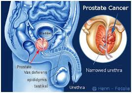 Learn more about the disease&#x27;s symptoms, tests, and treatments. Prostate Cancer Specialists In Germany Switzerland