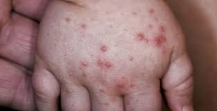 Hfm disease is a viral infection, so. Hand Foot And Mouth Disease Symptoms And Treatment Bupa Uk