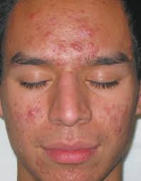 Acne and Rosacea: Epidemiology, Diagnosis and Treatment