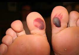 10 Enfermedades Dermatologicas De Los Pies Causadas Por El Calzado