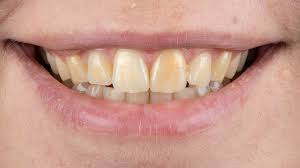When done the right way, teeth whitening is not bad for your health. Professional Teeth Whitening In Dentalcare Hook Dentalcare Hook