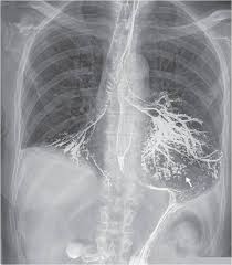 Bronchopulmonary Aspiration Radiology Humor Radiology Tech Radiology